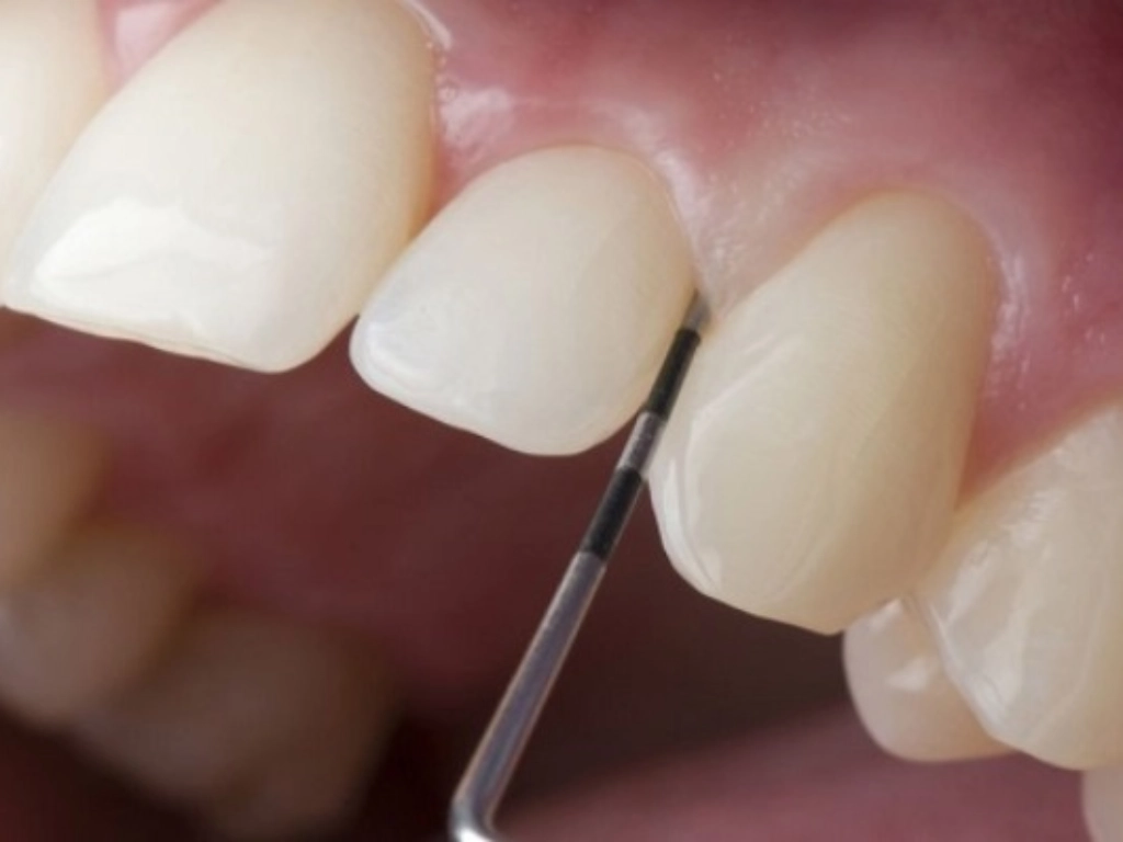 Tỷ lệ mài răng bọc sứ an toàn là từ 0.6mm đến 2mm